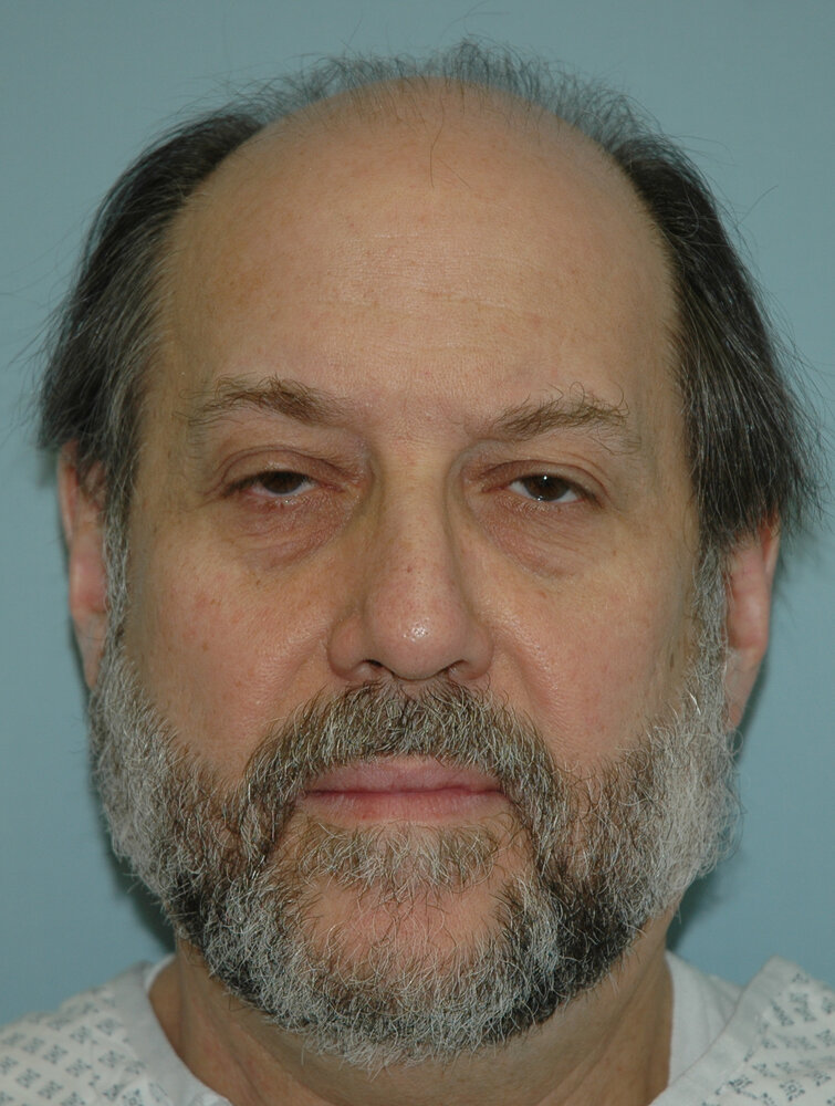 Real BEFORE photo of a man with hair loss, front view, neutral overhead light