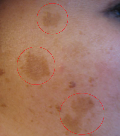 Real photo of melasma — symmetrical pigmentation on cheekbones and upper lip