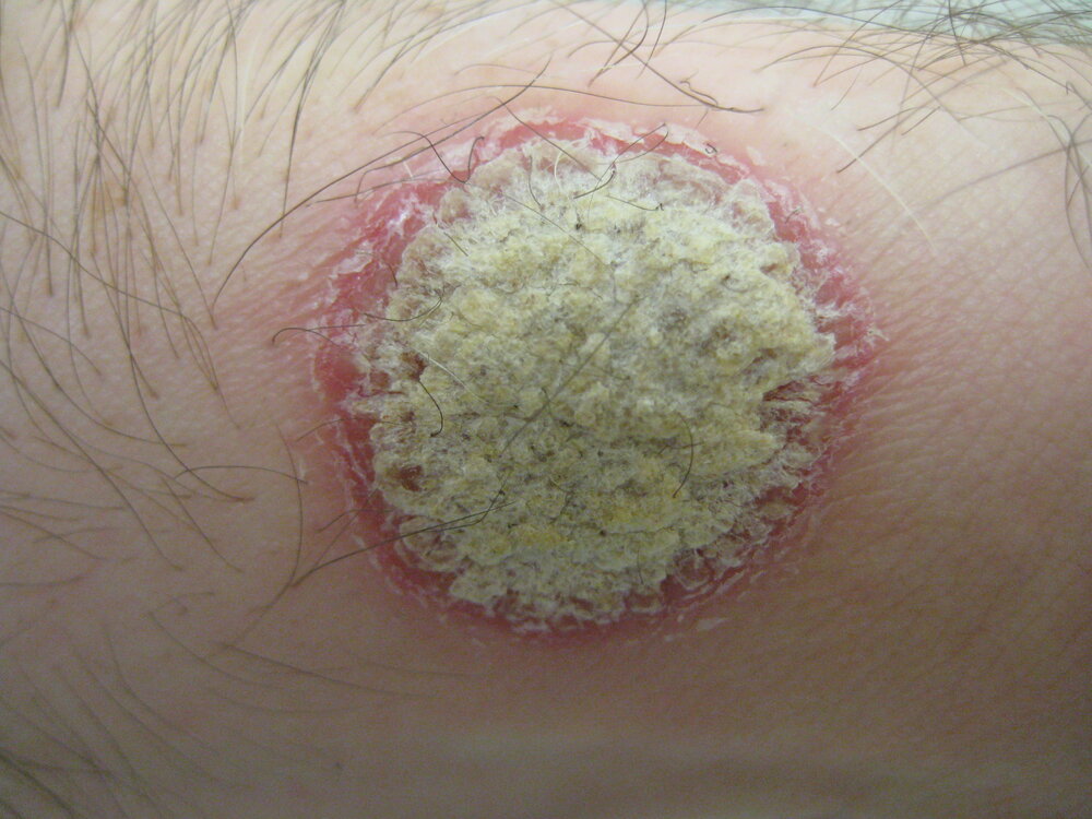 Real photo of a psoriasis plaque on the forearm, well demarcated